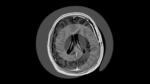 MRI examination of a male patient with a partially resected brain tumor