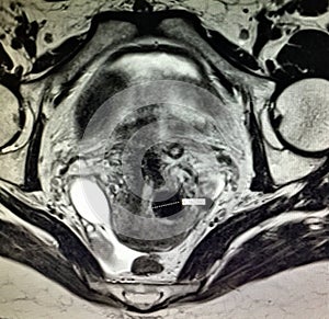 Fallopian tube neoplasm hematosalpinx pathology photo