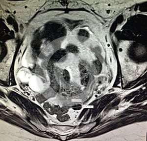 Fallopian tube neoplasm hematosalpinx pathology photo