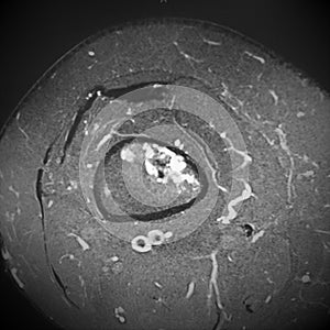 Mri femoral bone oncology sarcoma