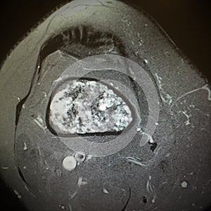 Mri femoral bone oncology sarcoma photo