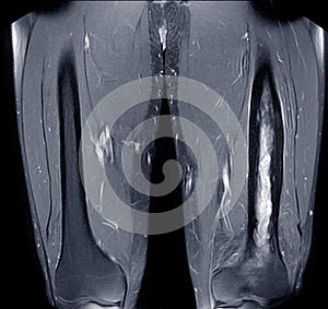 MRI Femur Impression : Chronic osteomyelitis