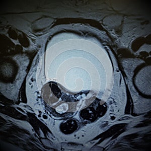 Mri fibroid necrotic uterus pathology exam