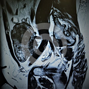 Mri fibroid necrotic uterus pathology exam photo