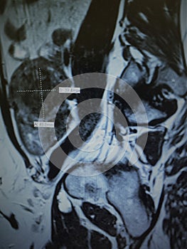 Mri fibroid necrotic uterus pathology exam photo