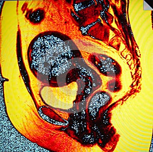 Mri of fibromyoma