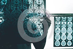 Alzheimer`s disease on MRI photo