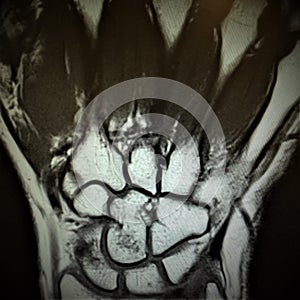Mri fracture bones wrist exam