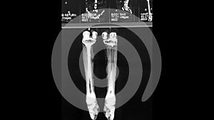 MRI HD Video of Knees, Femurs and Ankles