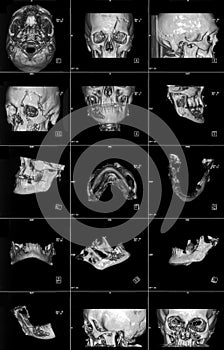 MRI of head