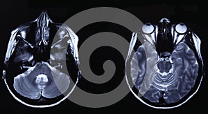 MRI of head