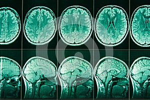 MRI of the head and brain of a person.