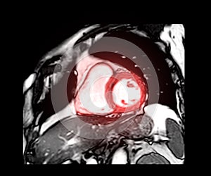 MRI heart or Cardiac MRI ( magnetic resonance imaging ) of heart short axis view for diagnosis heart disease