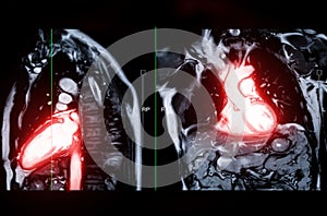 MRI heart or Cardiac MRI