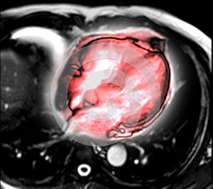 MRI heart or Cardiac MRI 4 chamber of the heart .