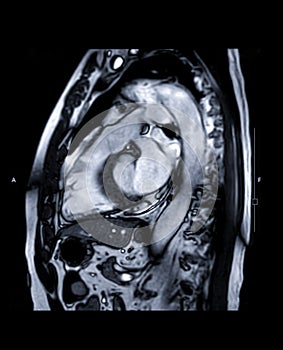 MRI heart or Cardiac MRI  magnetic resonance imaging  of heart  LVOT view .