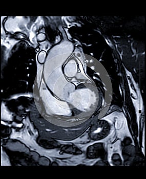 MRI heart or Cardiac MRI  magnetic resonance imaging  of heart  RVOT view.