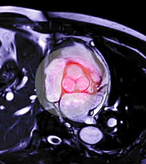 MRI heart or Cardiac MRI magnetic resonance imaging of heart showing aortic valve .