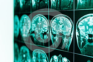 MRI of the human brain and brain in defocus