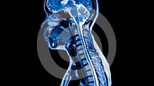 MRI of human spine in sagittal or lateral view.Diagnosis of spine metastasis with back pain.