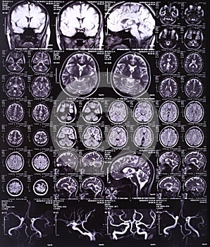 MRI image of the brain