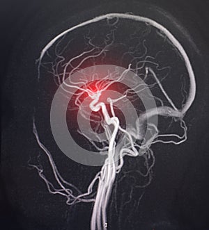 Obraz z mozek plavidlo. z nemoc mrtvice oběhový poruchy ateroskleróza 