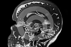 MRI image of cerebral lesion located in the middle line parietal -frontal area