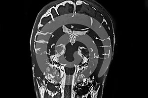 MRI image of cerebral lesion located in the middle line parietal -frontal area