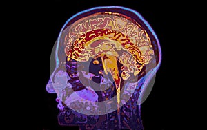 MRI Image Of Head Showing Brain