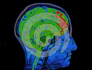 MRI Image Of Head Showing Brain photo