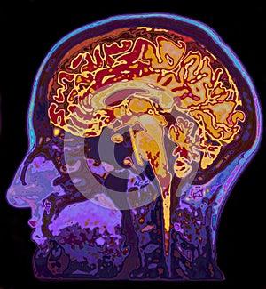 MRI Image Of Head Showing Brain photo