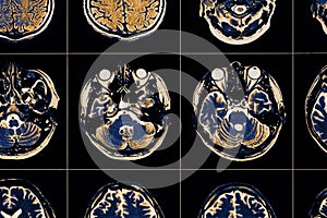 MRI image of human brain close-up