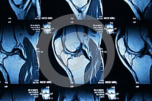MRI image of knee
