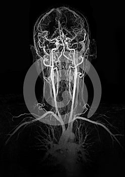 MRI image show head and neck vessel