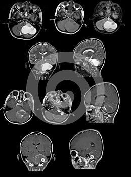 MRI image show a tumour in cerebellum