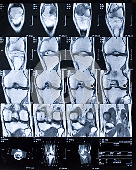 MRI Knee 3