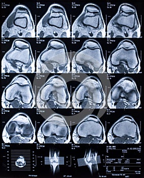 MRI Knee 4