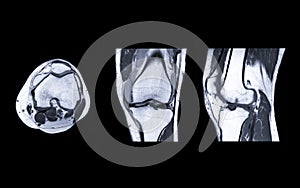 MRI Knee joint or Magnetic resonance imaging compare axial, coronal and sagittal view.