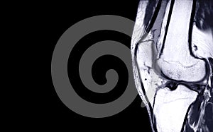 MRI Knee joint or Magnetic resonance imaging sagital view . photo