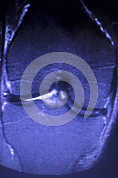 MRI knee meniscus tear scan