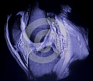 MRI knee meniscus tear scan