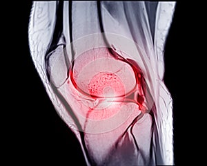 MRI knee sagittal PDW and TIW view for detect tear or sprain of the anterior cruciate  ligament & x28;ACL