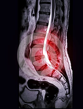 MRI L-S spine or lambar spine sagittal T2 technique for diagnosis spinal cord compression photo