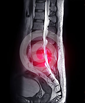 MRI L-S spine or lambar spine sagittal T2 technique for diagnosis spinal cord compression