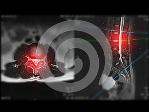 MRI L-S spine or lumbar spine Axial T2W view with sagittal plane for diagnosis spinal cord compression