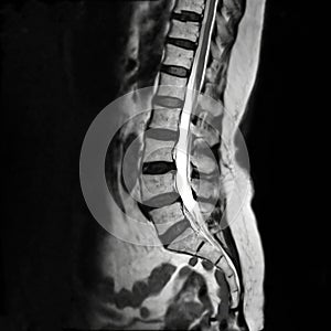 MRI L-s spine or MRI of lambosacral spine.