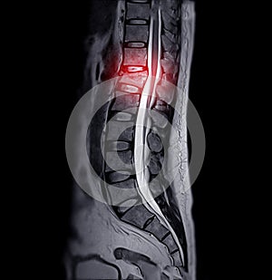 MRI of lambosacral spine or L-S spine .