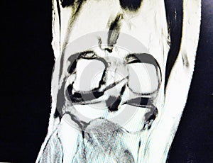 Mri lateral meniscus tear pathology