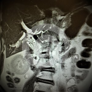 Mri liver ducts stones dilatation pathology exam