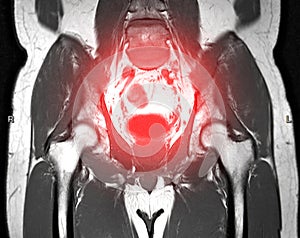 MRI Lower abdomen Coronal plane.